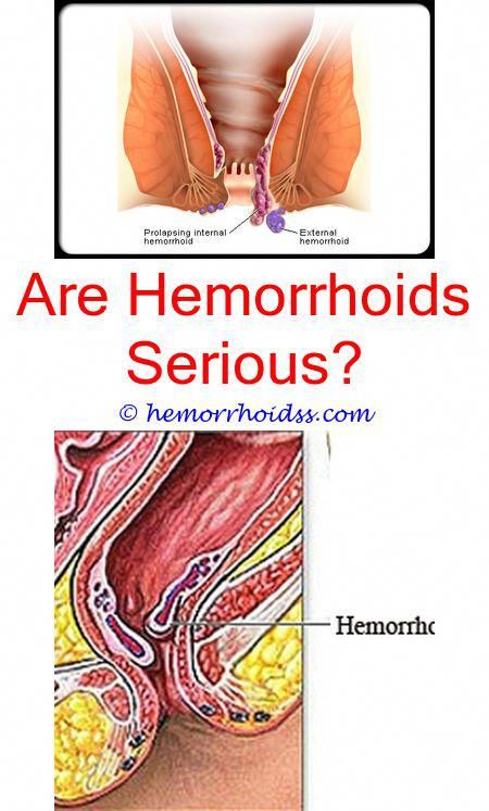 Do outside hemorrhoids go away. Hemorrhoids