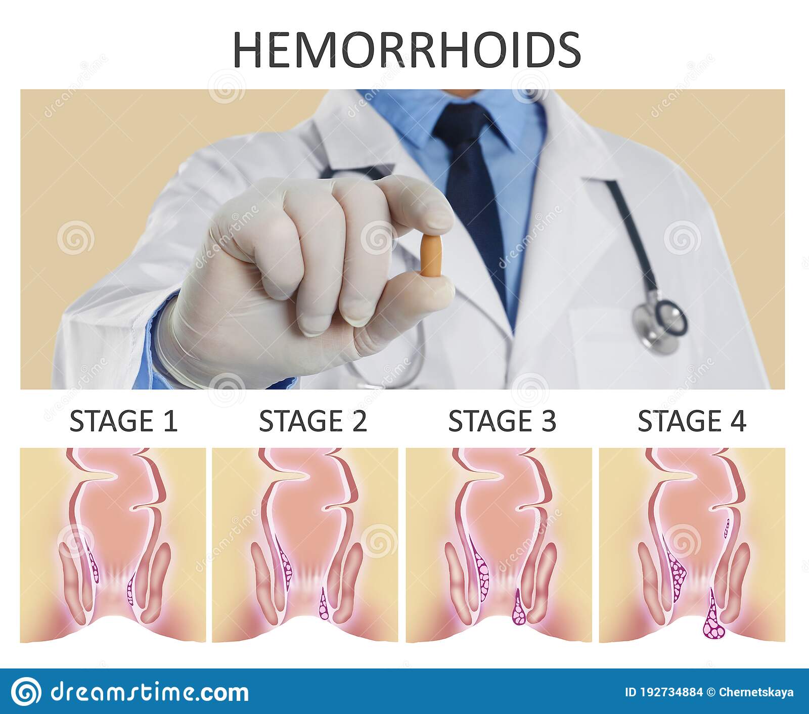 Doctor Holding Suppository For Hemorrhoid Treatment Over Illustration ...