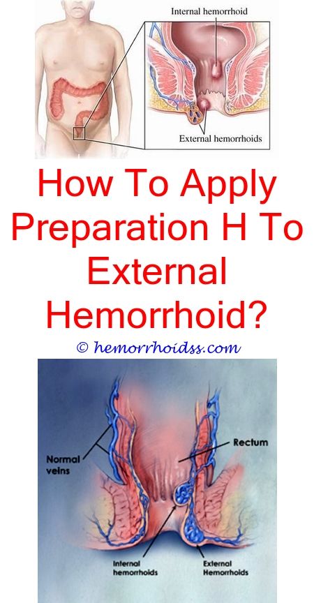 Does Ice Help External Hemorrhoids? do hemorrhoids hurt ...