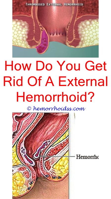 Does Preparation H Shrink Hemorrhoids?