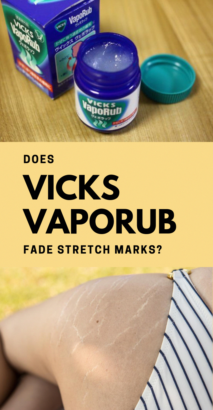 Does Vicks VapoRub Fade Stretch Marks? #vicks