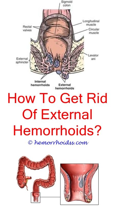 Does Witch Hazel Heal Hemorrhoids? does preparation h work ...