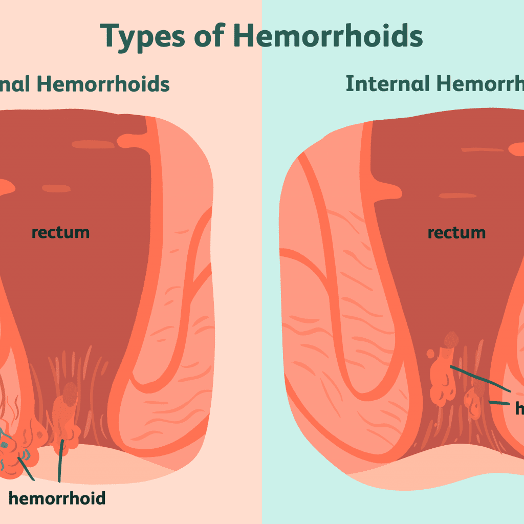 Top 98+ Images rectal prolapse vs hemorrhoids photos Updated