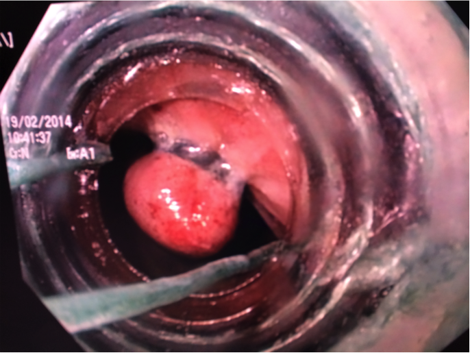 Endoscopic Rubber Band Ligation of Internal Hemorrhoids: Turning ...