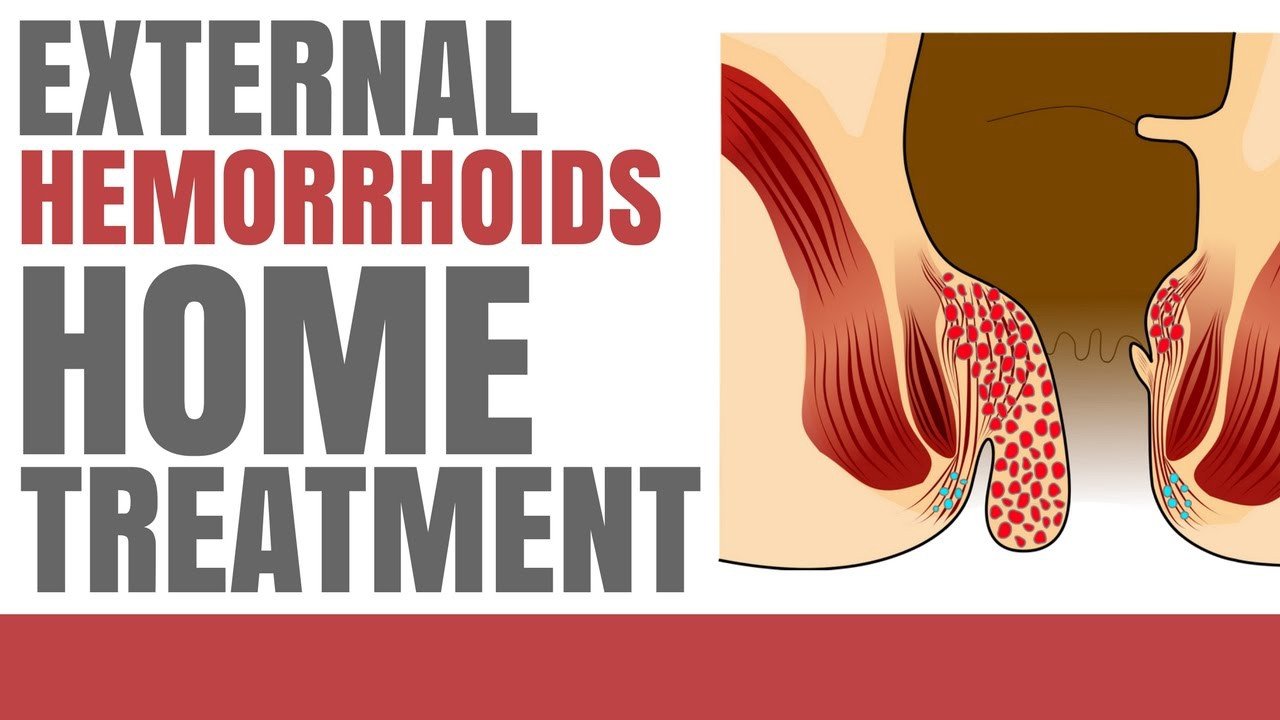 External Hemorrhoids Cure at Home