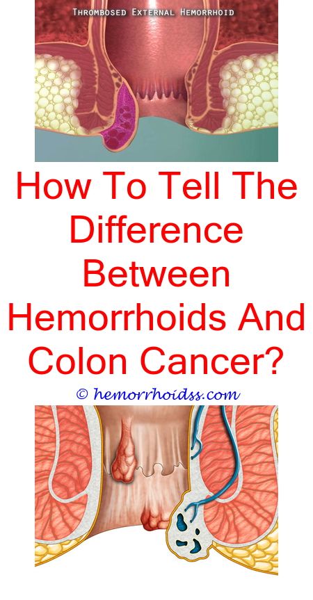 Fascinating Cool Ideas: Are Having Hemorrhoids Mormsl? how ...