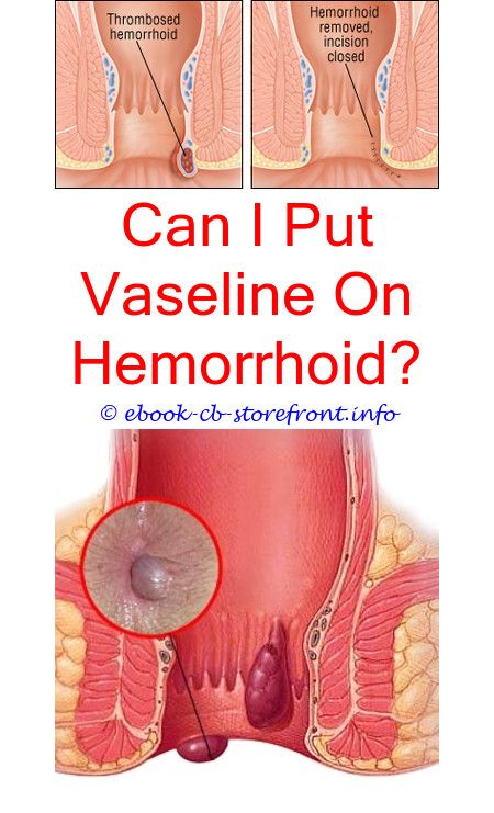 Fascinating Useful Ideas: Are All Hemorrhoids Cancerous ...