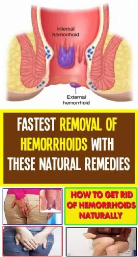 Fastest Removal of Hemorrhoids With These Natural Remedies !