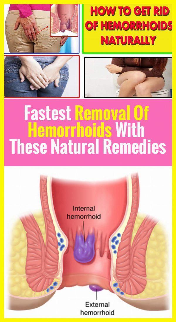 Fastest Removal Of Hemorrhoids With These Natural Remedies