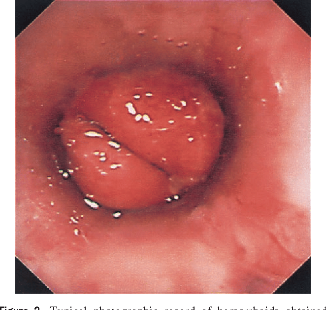 Figure 2 from Hemorrhoid banding using videoendoscopic anoscopy and a ...