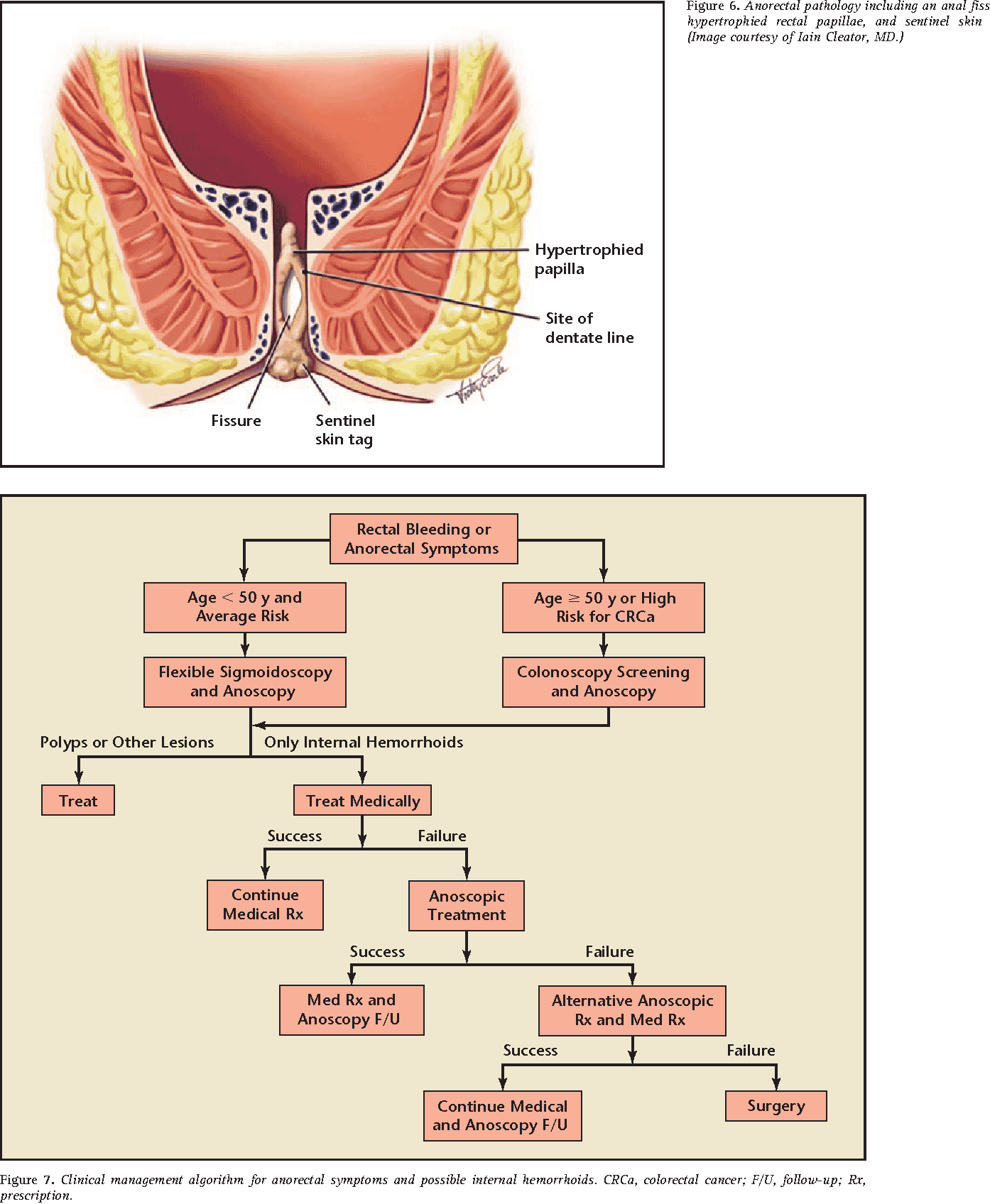 Figure 7 from Definitive therapy for internal hemorrhoids