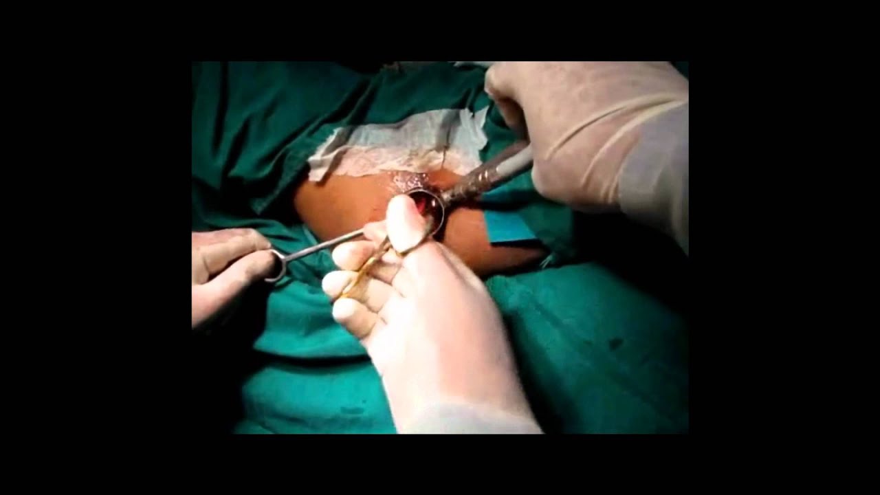 Haemorrhoid Surgery Dr Kushal Mital