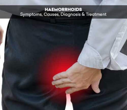 Haemorrhoids: Symptoms, Causes, Diagnosis &  Treatment