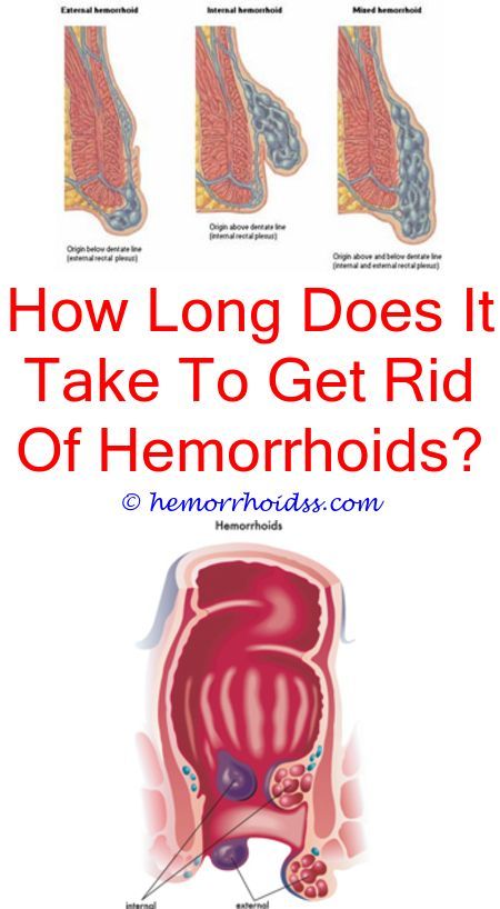 Have I Got Hemorrhoids? how do you get a hemorrhoid to go ...