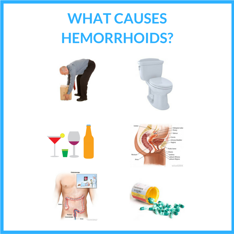 Hemorrhoid Causes Guide 101: Discover What Causes ...