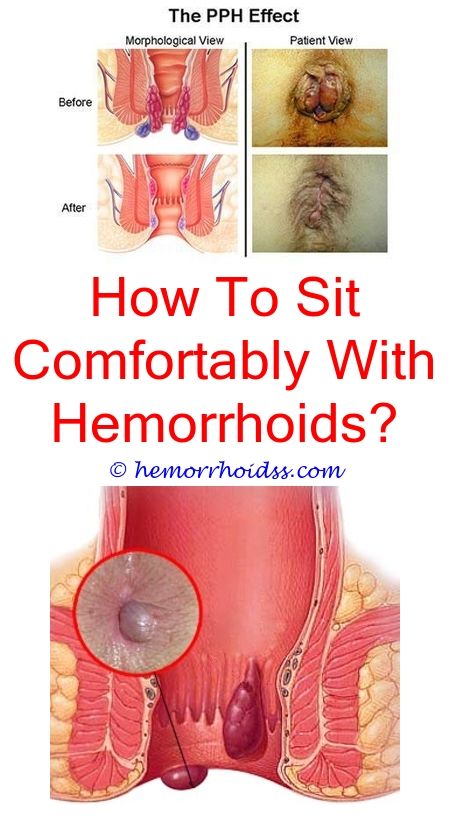 Hemorrhoid Home Treatment Pregnancy