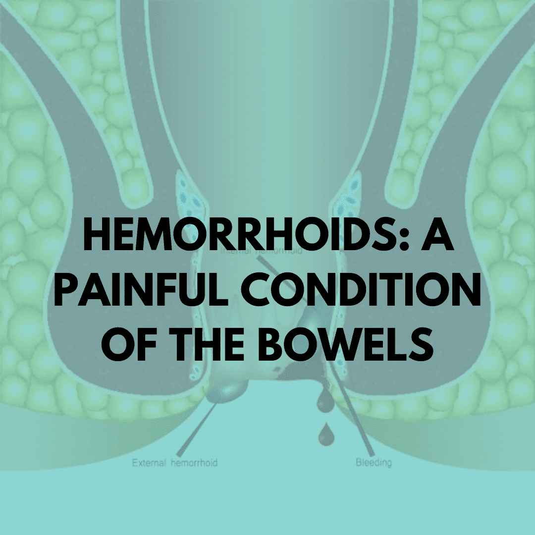 hemorrhoids a painful condition of the bowels niruja healthtech