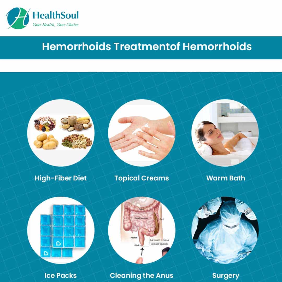 Hemorrhoids: A Source of Pain and Blood â Healthsoul