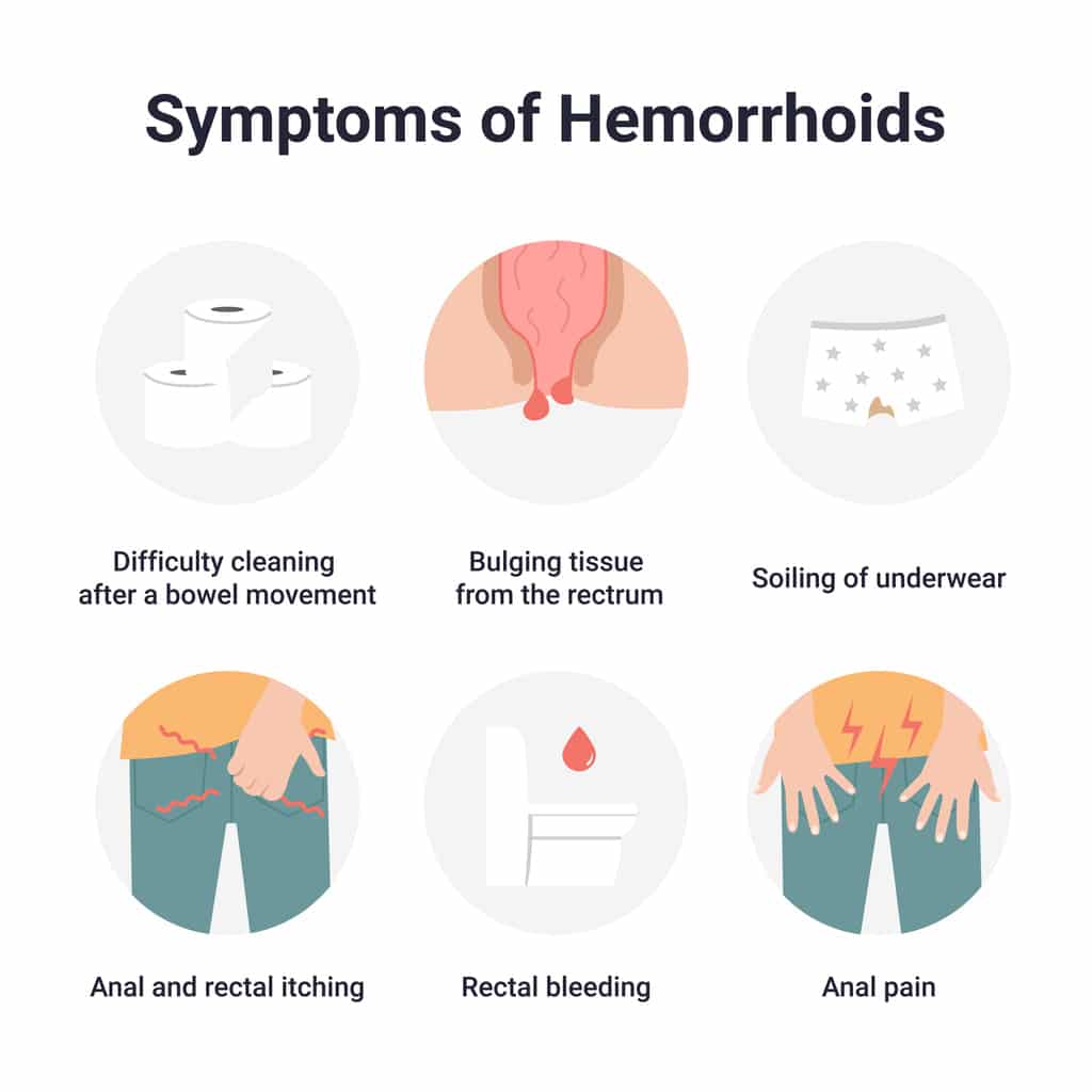 Hemorrhoids and What to do About Them