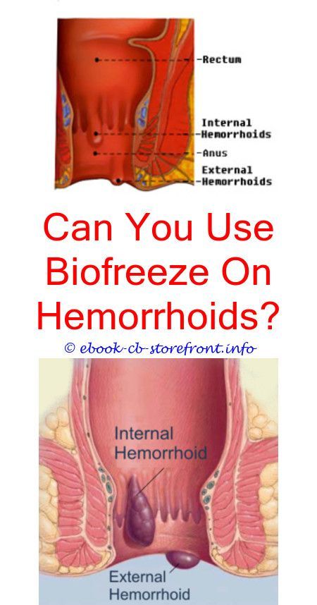 Hemorrhoids are commonly quite distressing, yet a little ...