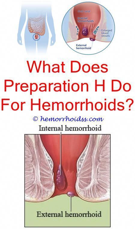 Hemorrhoids are normally not severe, but they can be ...
