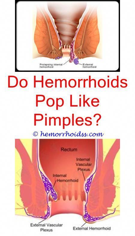 Hemorrhoids are usually not severe, yet they can be annoying as well as ...
