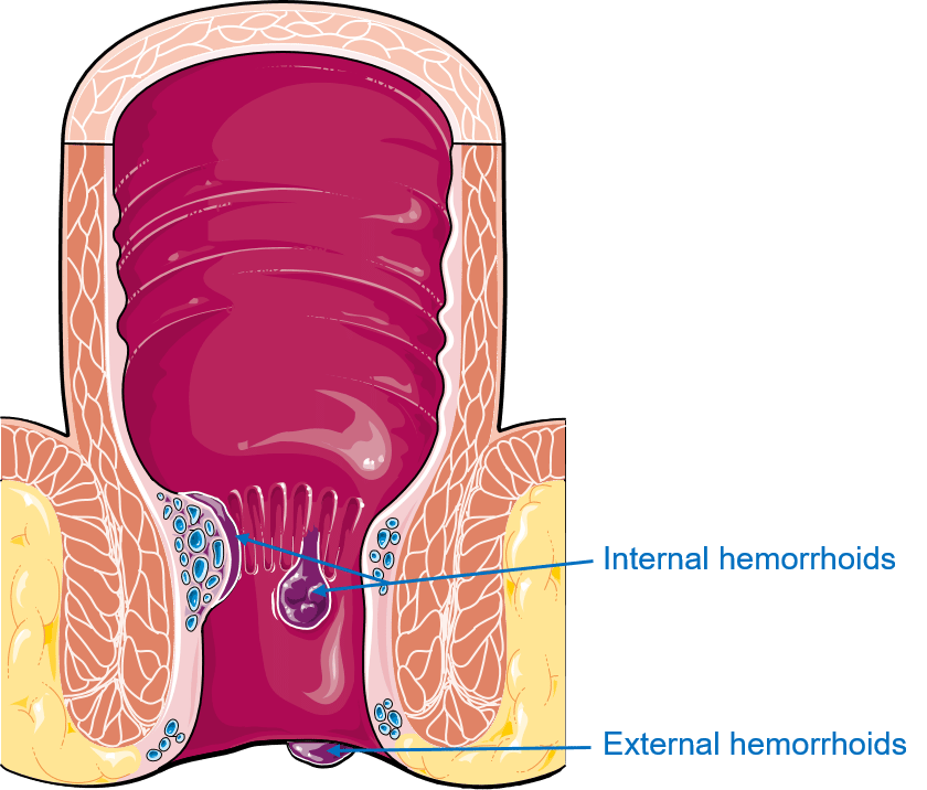 Hemorrhoids: Are you at risk?