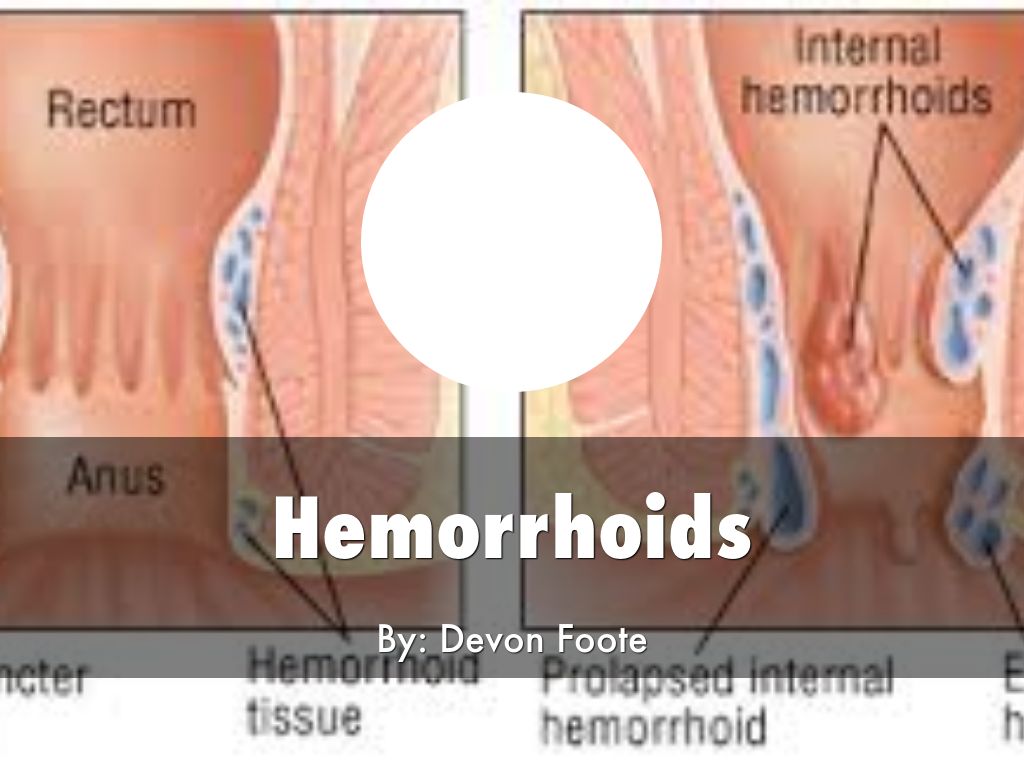 Hemorrhoids by dfoote96