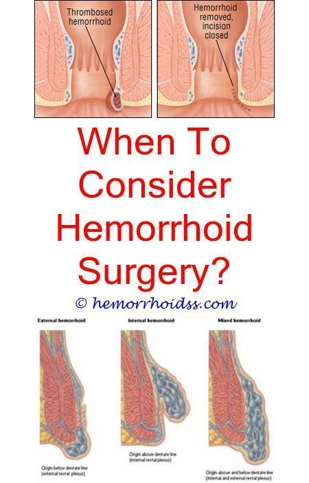 Hemorrhoids can appear all of a sudden, and they are ...