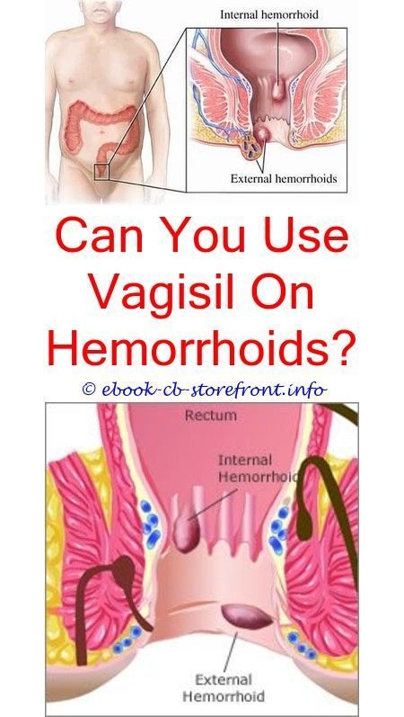 Hemorrhoids can be incredibly unpleasant and very painful. If you have ...