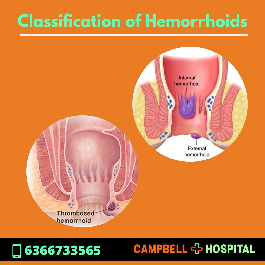 Hemorrhoids: Causes Symptoms And Treatment â Break Out Of The Box