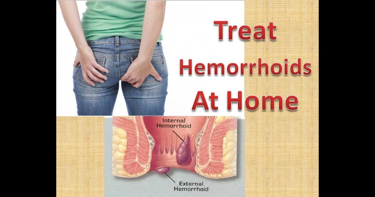 Hemorrhoids external