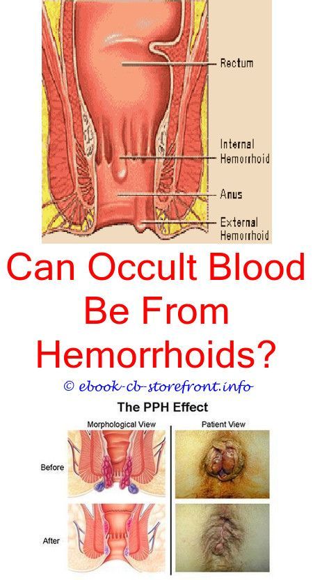 Hemorrhoids impact numerous victims and create steady irritation. As ...