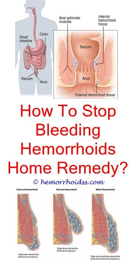 Hemorrhoids In Stool