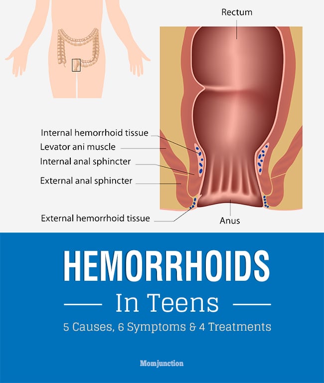 Hemorrhoids In Teens  Causes, Symptoms And Treatment