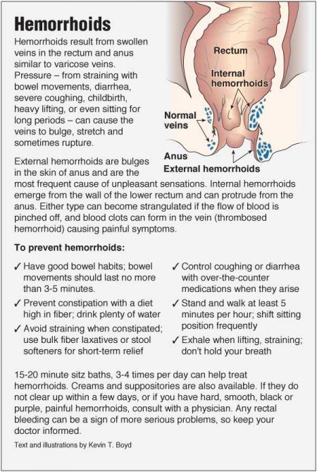 Hemorrhoids  PointFinder Health Infographics