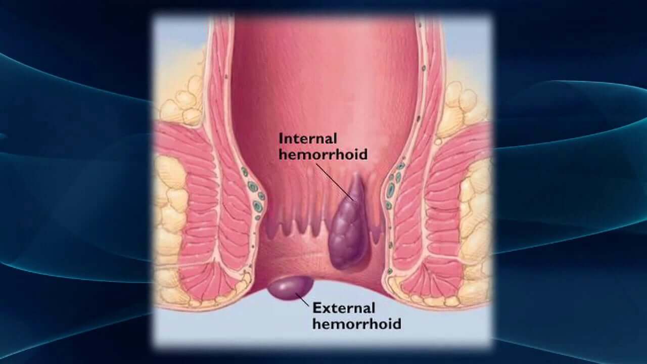 Hemorrhoids Saviour Review: A Cure To Save You From ...