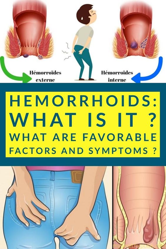 Hemorrhoids: What is it ? What are favorable factors and ...