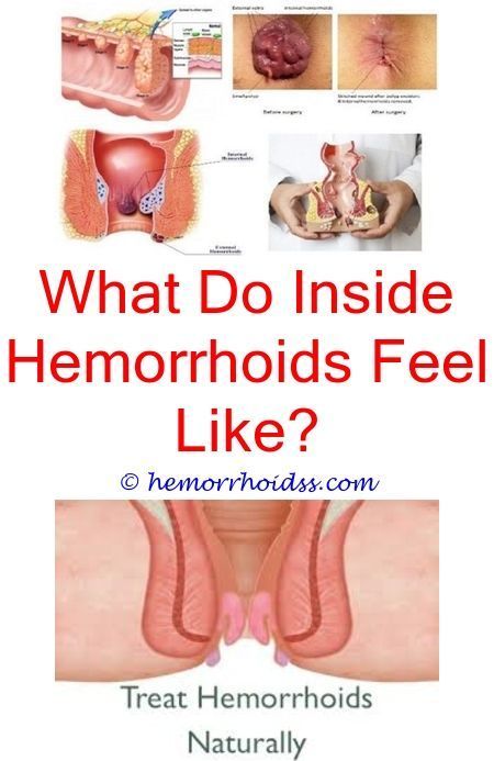 hemorrhoidsstreatment do external #hemorrhoids go away ...