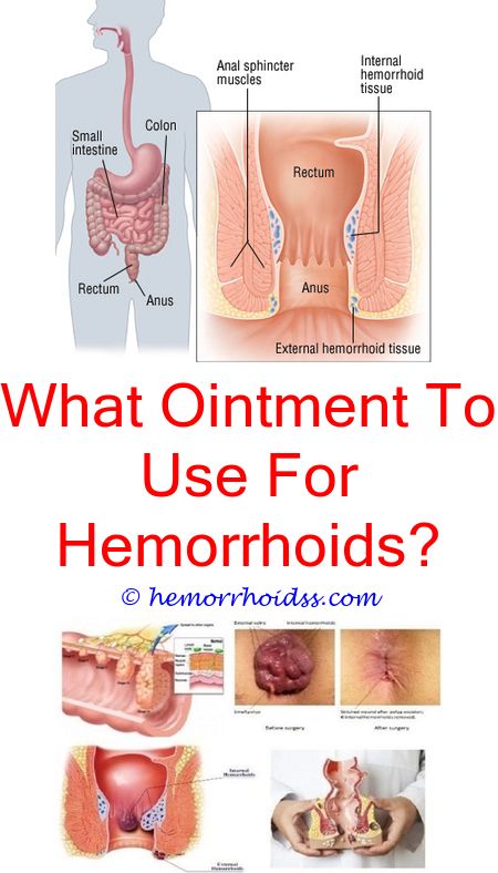 #hemorrhoidtreatment what happens when your hemorrhoids ...