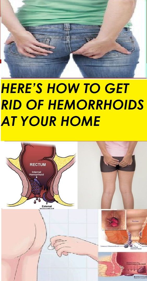 HERES HOW TO GET RID OF HEMORRHOIDS AT YOUR HOME