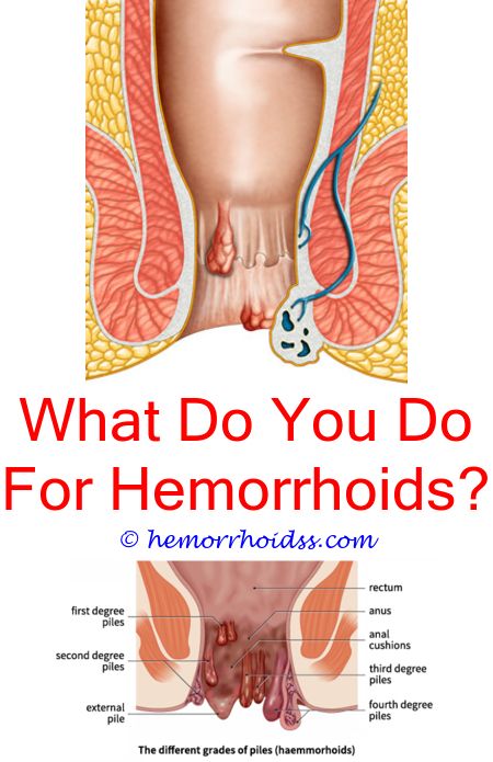 How Can You Help Hemorrhoids?