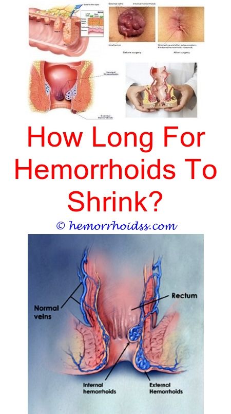 How Do I Get Rid Of Hemorrhoids Without Surgery ...