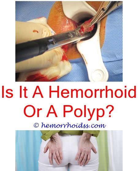 How Do I Make My Hemorrhoids Go Away
