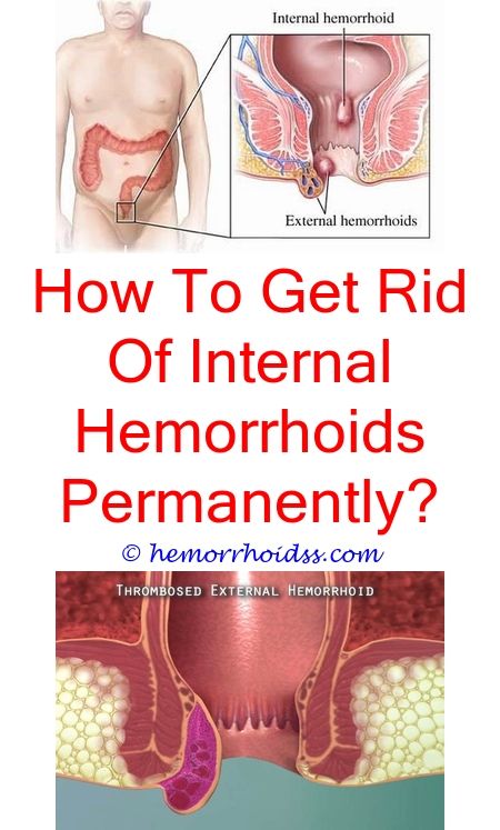 How Do People Get Hemorrhoids?