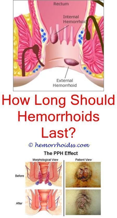 How Do You Cure Hemorrhoids