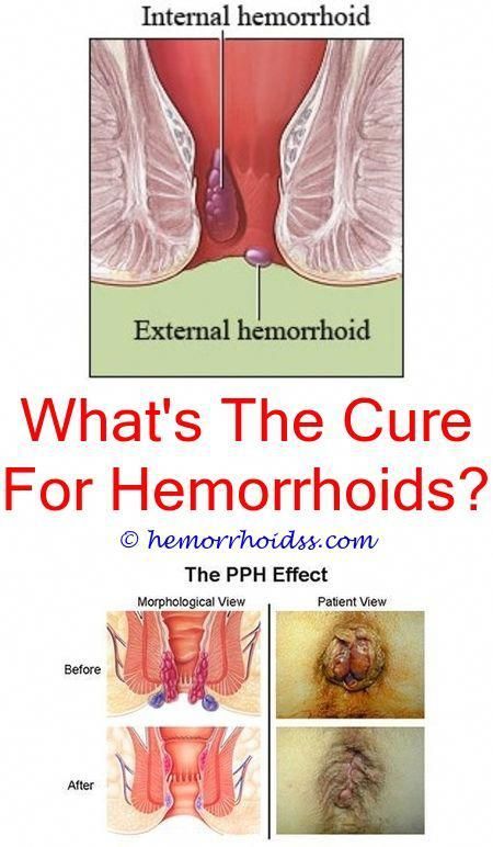 How Do You Deal With Hemorrhoids Disease?