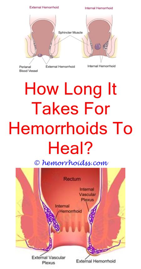 How Do You Get Hemorrhoids To Go Away?