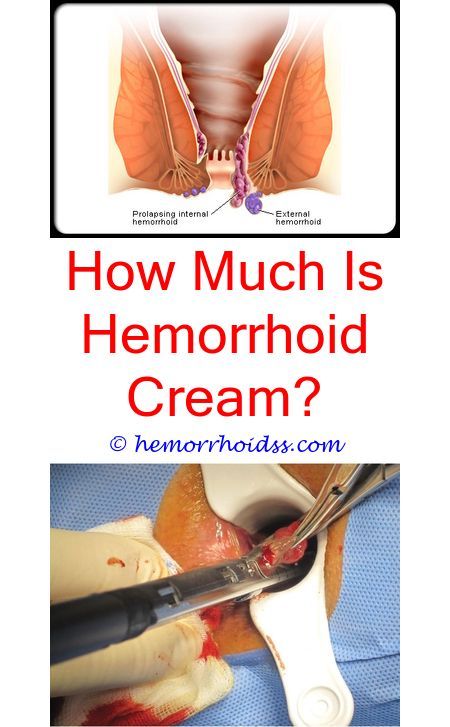 How Do You Know If You Have External Hemorrhoids? does ...
