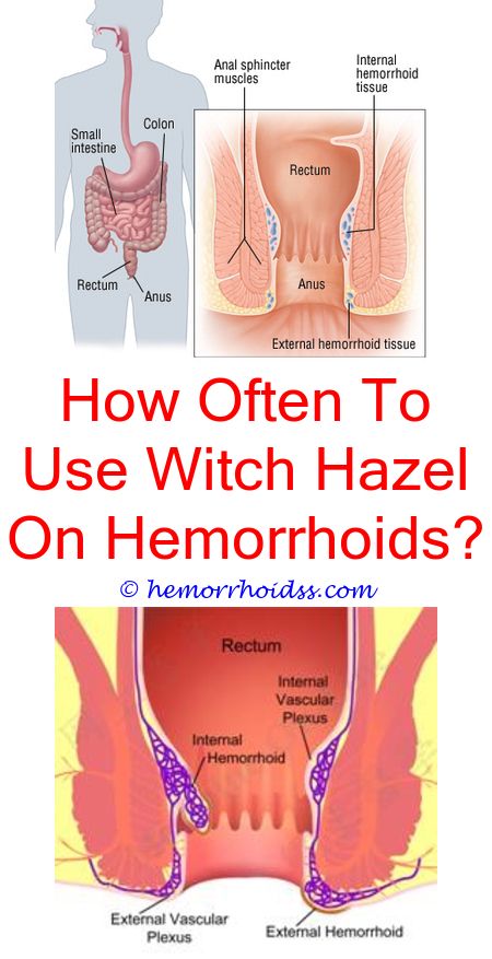 How Do You Know If You Have Hemorrhoids?
